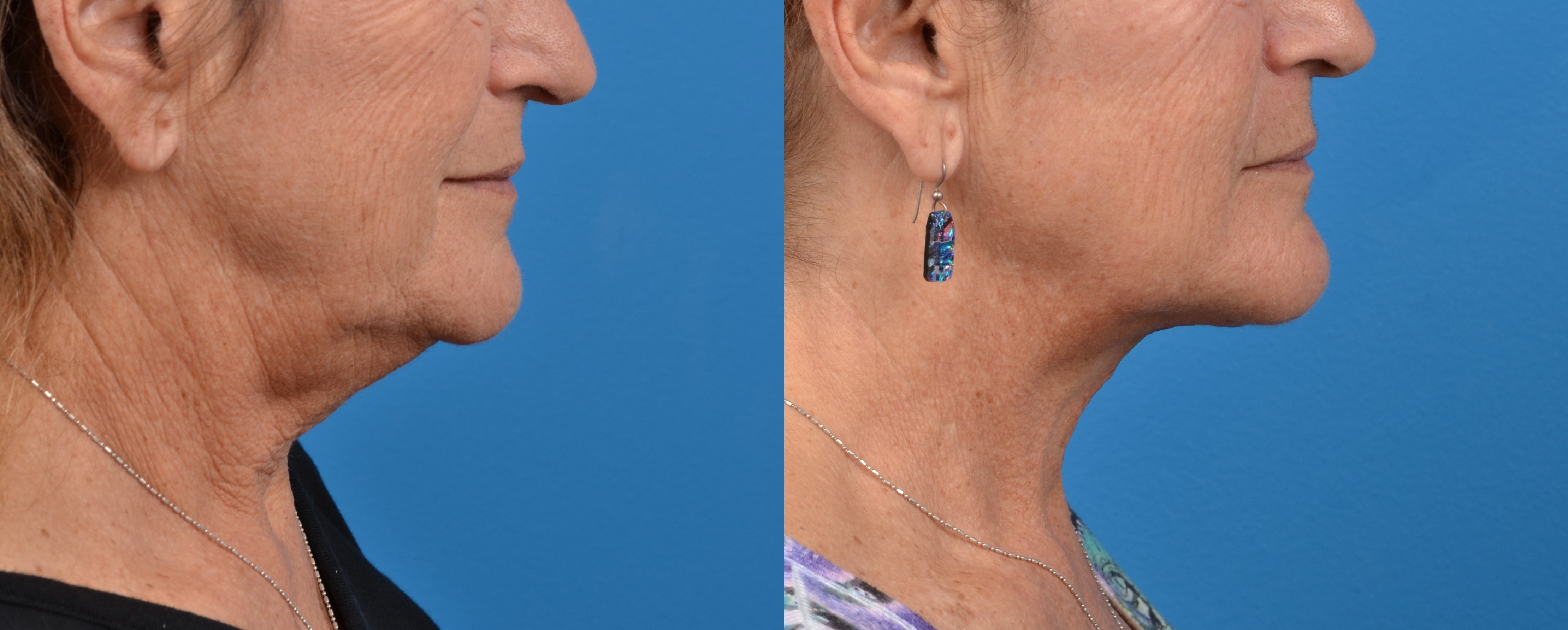 Profile Neck Lift Photos Melbourne Fl Patient